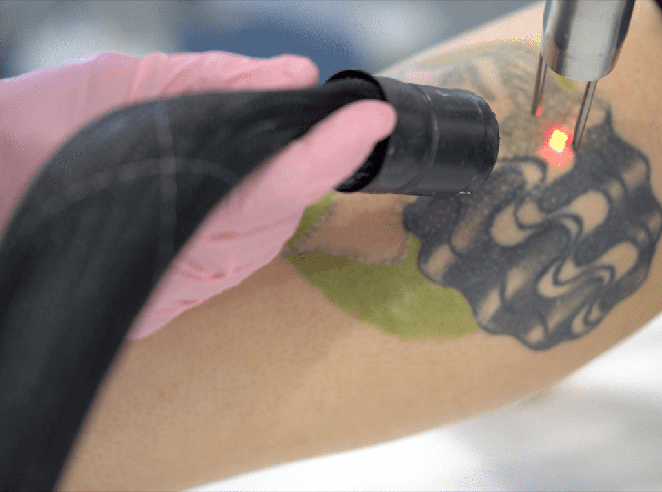 laser away tattoo removal 1